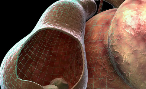 肾结石三毫米可以碎吗