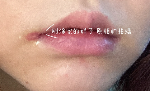 经常烂嘴角可能是免疫力差的原因吗