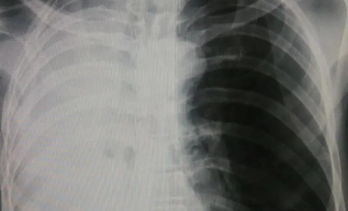 白肺症状表现有哪些