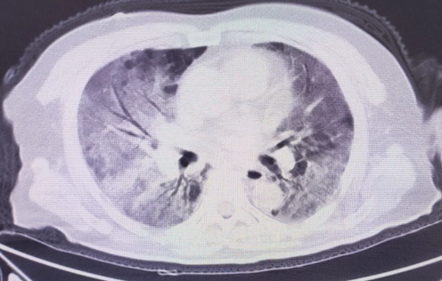 白肺症状表现有哪些