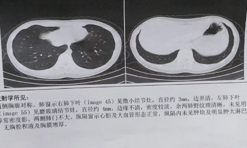 什么情况需要做肺部CT