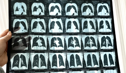 什么情况需要做肺部CT