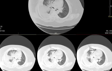 如何自查是否出现白肺