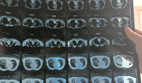新冠白肺可逆吗