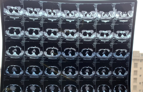 新冠白肺可逆吗