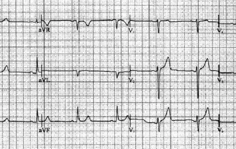 窦性心律不齐会引起胸闷气短呼吸困难吗