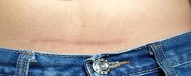 肚子上有疤痕.jpg