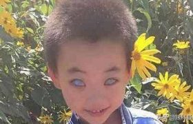 青光眼的症状（形形色色的青光眼）
