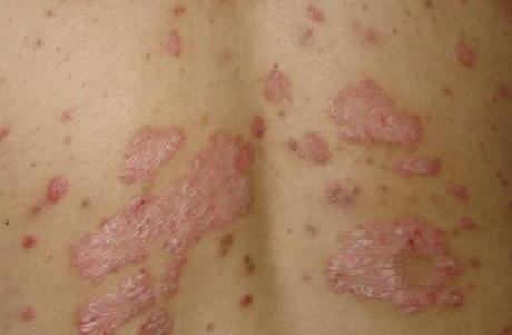 艾滋病一开始的皮肤图女性