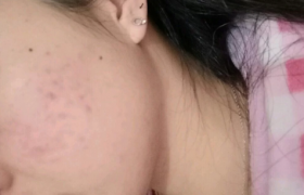 为什么吃了异维a酸反而长痘