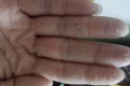 手脱皮还痒是怎么回事