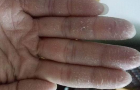 手脱皮还痒是怎么回事